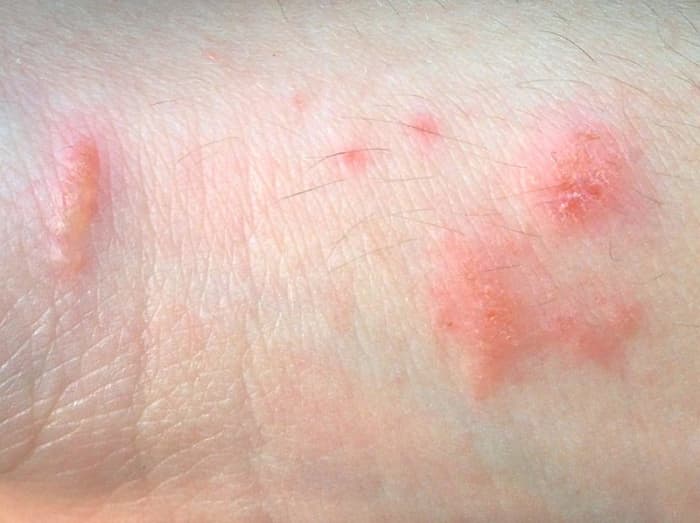The rash formed by contact with urushiol oil on poison ivy leaves may spread if the oil is not removed. Scratching may spread the oil across the surface of the skin. It is vital to cleanse the affected area with a soap as soon as possible.