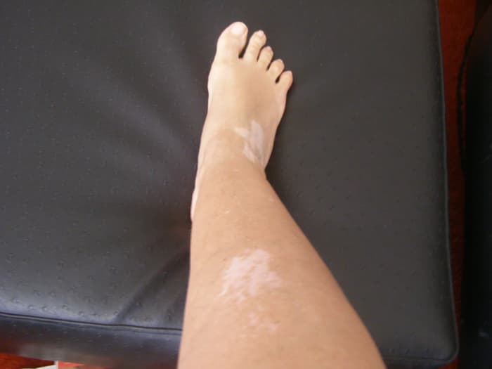 Leg showing vitiligo patches. Since this photo was taken the skin on my leg is now almost all white.