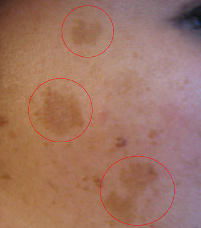 A case of Melasma, a particularly common affliction in women taking oral contraceptives or hormone replacement therapy.