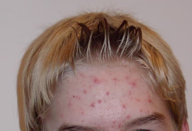 Acne can be cleared up with proper diet and good facial care. Steaming is a gentle, effective way to open up and clean out those pores.