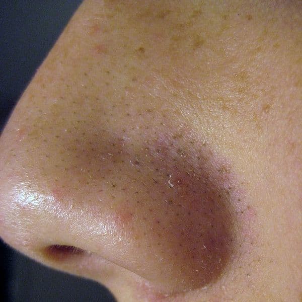 Blackheads are a combination of sebaceous oils that have mixed with dust and are stuck in the pores. Facial steaming will open them up so that a honey or eggwhite masque can be applied with pads to help pull the dirt out.