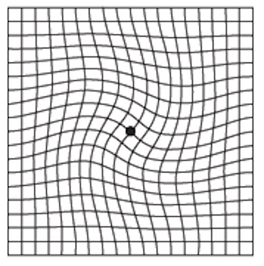 What a person may see if they have macular pucker. A person with macular degeneration may see the same thing since both diseases affect the macula but they are not the same disease. For my condition, the lines are wavy but not this dramatic.