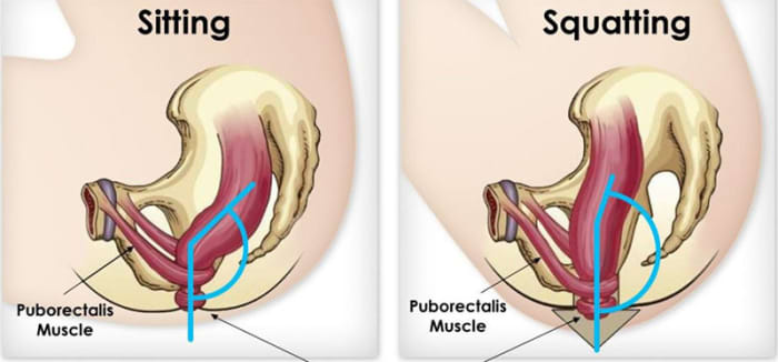 It is much more difficult to pass stool in the sitting position than in the more natural and anatomically friendly squat.