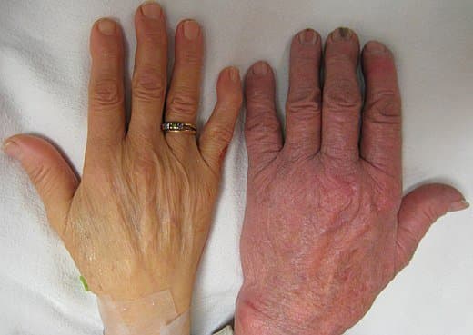 "The hand of a person with severe anemia (on the left) compared to one without (on the right)."