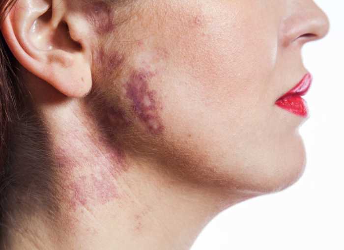 Two Ways to Cover a PortWine Stain (One You Can Do at Home) HealthProAdvice