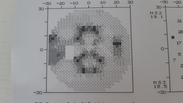 Results of test in left eye, notice problematic dark areas. I was put on eye drops for glaucoma after this test.