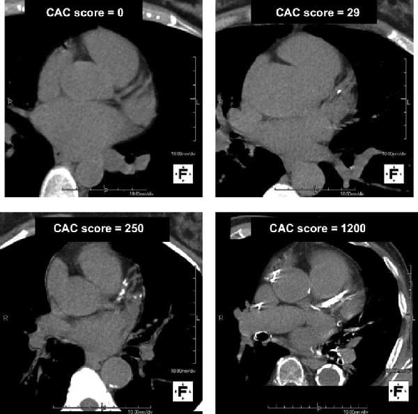 CAC scans offer 360-degree views (through 180 degrees of rotation) of the calcification in the heart's arterial network and its exact location, facilitating closer monitoring between repeat scans.