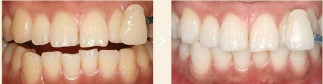 Before and after tooth whitening
