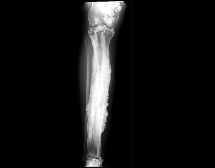 Bone resorption is the process of braking down the bones into its mineral and collagenous constituents through a cellular mechanism.