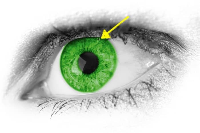 Laser iridotomy makes a small pinhole in the peripheral of the iris to eliminate glaucoma pressure.
