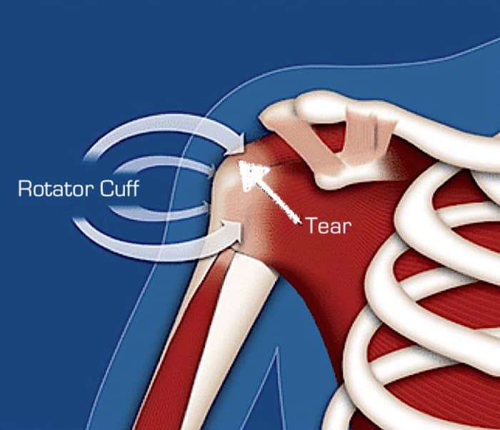 How I Avoided Shoulder Surgery for a Torn Rotator Cuff - Patient's Lounge