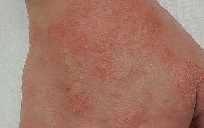 Typical manifestation of eczema. A red, slightly raised rash, often accompanied by tiny, fluid filled blisters.