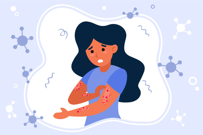 Eczema, also known as atopic dermatitis, is a disorder that affects the skin and is characterized by redness, dryness, and itching.