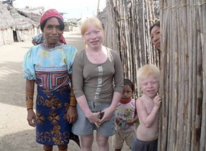 “Deadly tropical sun for the albinos of Panama’s ethnic Kuna” (Credit to Costa Rica Star News