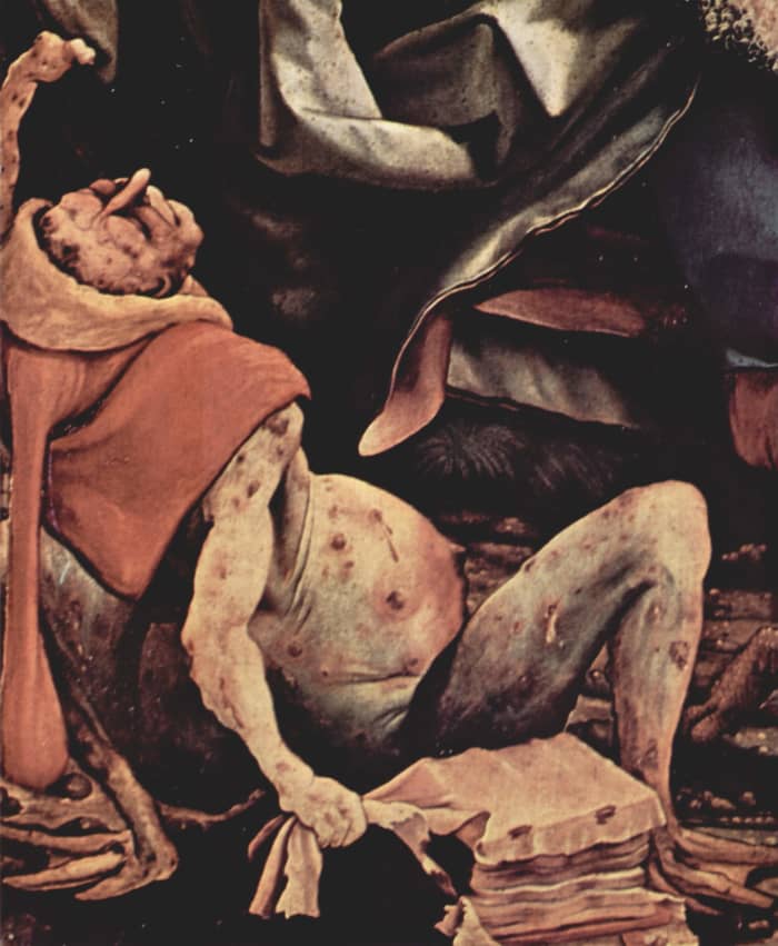 Saint Anthony's Fire, an affliction caused by ingesting rye bread contaminated with the fungus Claviceps purpurea.
