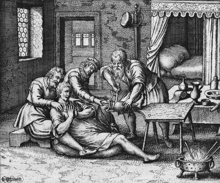 A patient is restrained as his limb is amputated. Burning brands are on-hand to cauterise the wound.