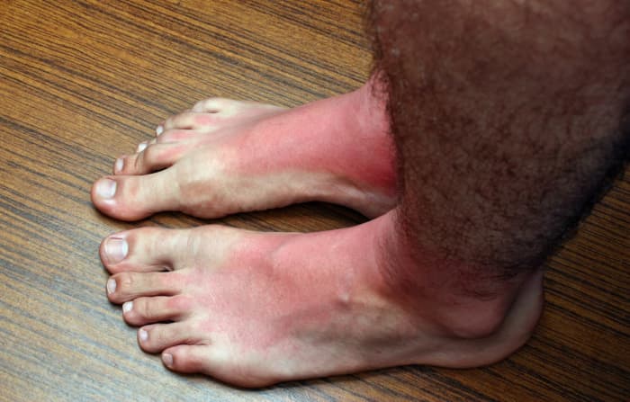 10 Tips to Soothe, Heal, and Prevent Sunburnt Feet - YouMeMindBody