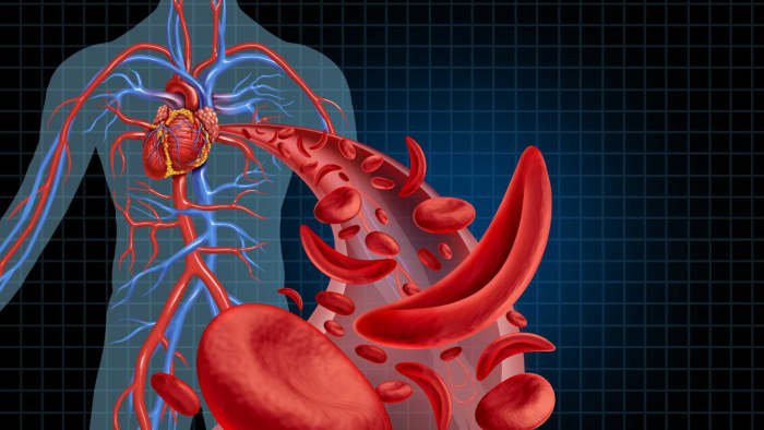 Sickle Cell Disease Or Anemia And Crispr-cas9 Genome Editing - Owlcation