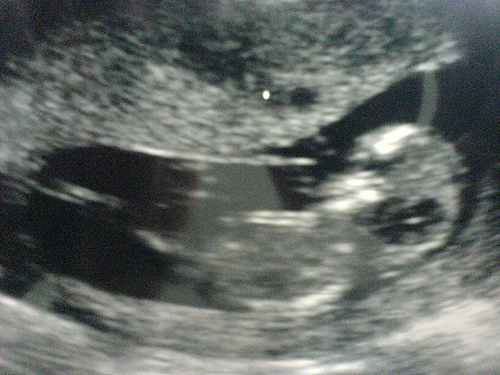 12 week baby scan