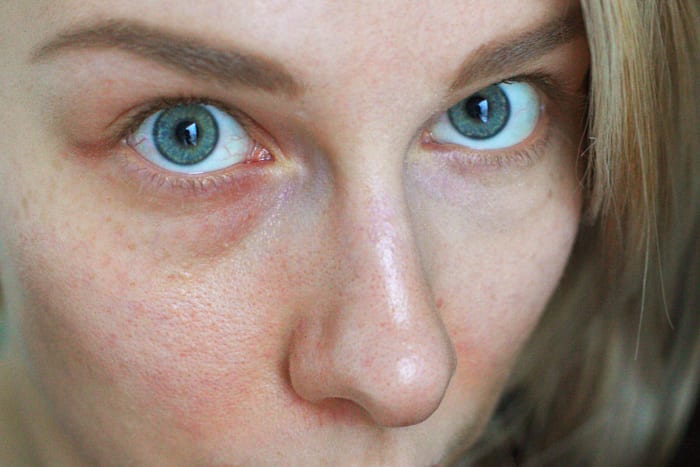 You most likely have sensitive skin if you experience redness or even rashes and itchiness after using certain products.