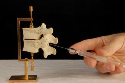 Image showing how the needle is introduced between the vertebrae for spinal anesthesia or epidural anesthesia.