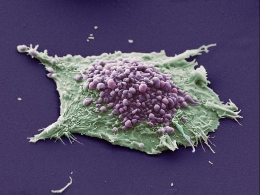 A fake-colour image of a blebbing cancer cell. The jagged edges show the cell is cancerous. Blebbing can be seen in purple. Each bleb will fall away (hence 'apoptosis') and be consumed by white blood cells