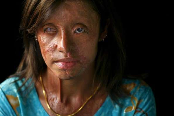 This Pakistani woman was blinded and scarred from an acid attack when her family could not pay her dowry. Many other women suffer worse disfigurment.