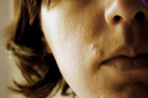 Pimples, zits, and skin blemishes are a common problem for people all over the world. Take charge of your blemish with a home remedy!
