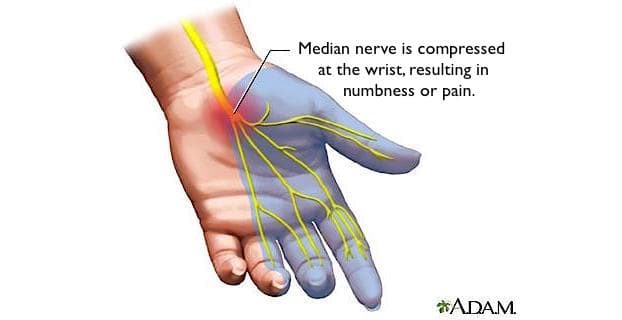 When the Carpal Tunnel is inflamed from irritation, it can put pressure on the Median Nerve that goes through the tunnel.