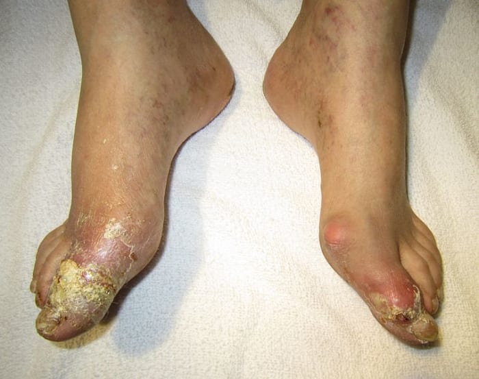 Here you can see a person with bad gout in the feet. Notice how the feet are swollen. The condition is really bad in the big toe.