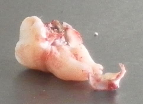 A difficult lower jaw wisdom tooth to extract. This came out in 3 pieces. Note the decay at the crown end (left) and the hooked root (right).