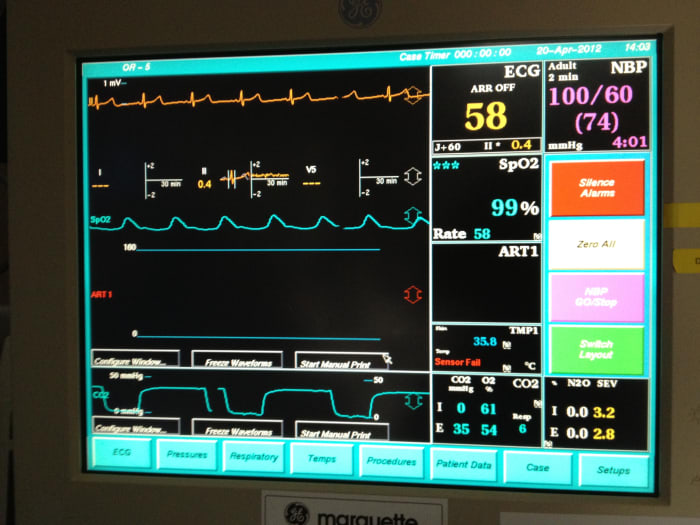 Hemodynamic monitoring during anesthesia involves watching the heart rate and rhythm, the blood pressure and your oxygen level. These are just a few of the monitors the anesthesiologist uses to keep you safe and comfortable for your surgery.