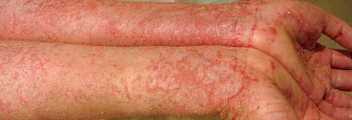 Red, scaly patches of eczema cover hands and arms, demonstrating how severe eczema can get.