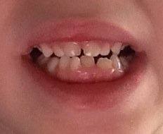 My son's mouth was too small for the adult teeth to come in properly. A lateral incisor and both canines needed to be pulled out.
