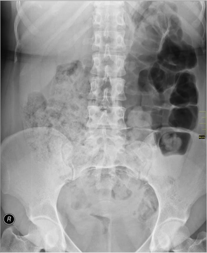 The gas is the cloudy, billowy patterns you see in the lower abdomen.