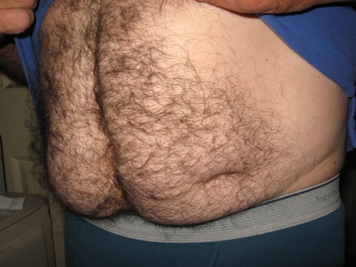 You can still see where the stoma hole was, 24 years after colostomy surgery. The midline incision divides the tummy in half, too.