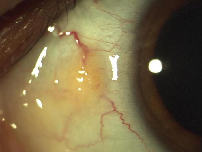 A pinguecula can make a person's eyes look less attractive.