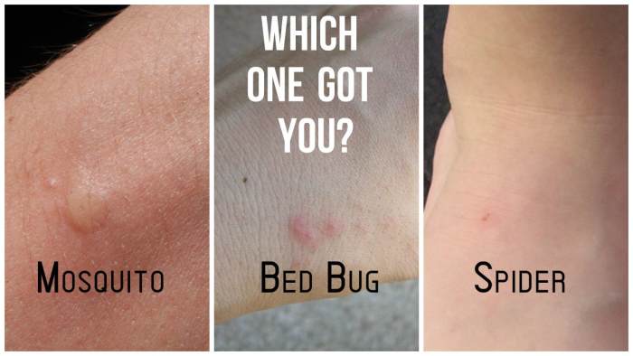 Bed bug bite (by hiroo yamagata on flickr); spider bite (by Jinger on flickr); and mosquito bite (by Josh).