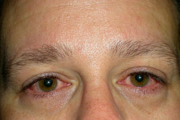 Itchy, red, and watery eyes are often associated with allergies or hay fever, but they can also indicate problems with your thyroid.
