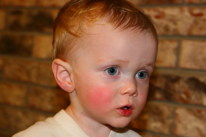 Cheeks red with fever, this little one simply needed some Tylenol (acetaminophen) and time to recover from a virus.