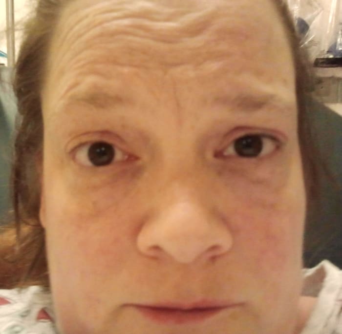 This person believes that her gallbladder is trying to kill her. Don't try this at home, folks. (Yes, this was after the morphine and no, I do not know how one eye got higher than the other.)