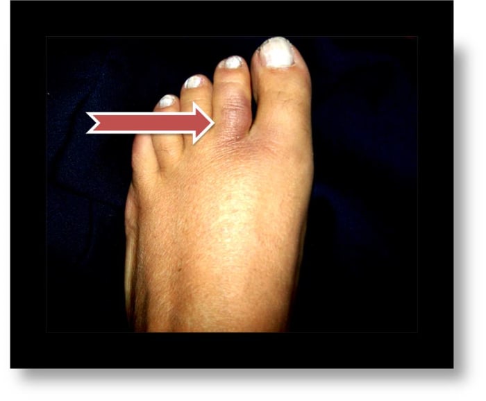 How to Treat an Injured or Broken Toe by Buddy-Taping - HealthProAdvice