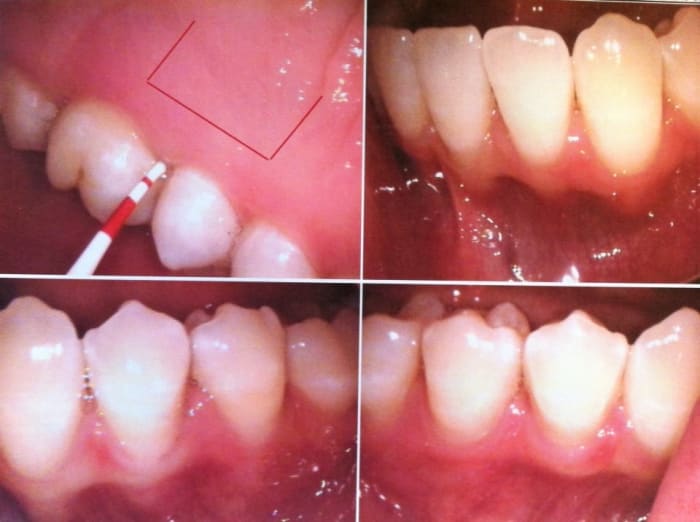 The shape in the upper left image demonstrates the flap that was opened at the roof of my mouth and used to source material that will reinforce some of my recessed gums.