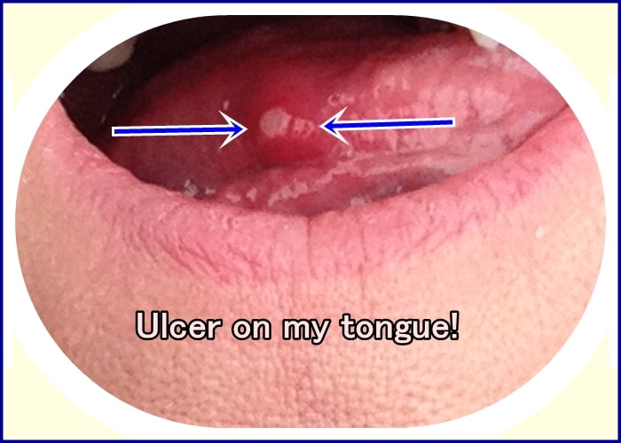 My own problems with mouth ulcers prompted me to research home remedies and products that worked - and to share them in this article.
