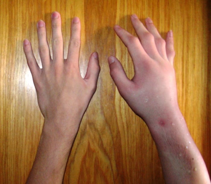 Picture Of A Bee Sting Reaction. Compare the right hand to the left. There is lots of swelling in the right hand.