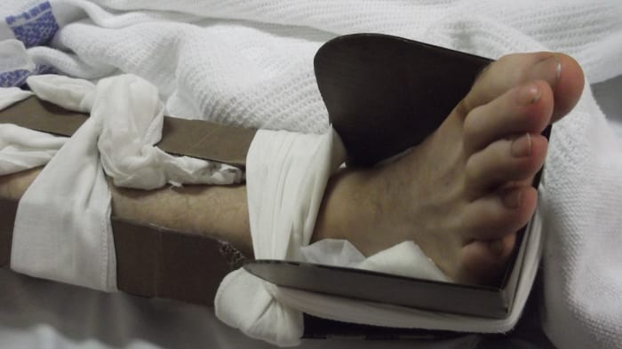 Photo of my husband's broken ankle, ready for ambulance transport from a small country hospital to a large city hospital. In less than an hour, the swelling was already significantly reduced.