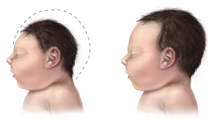 A side-view illustration of a baby with microcephaly (left) compared to a baby with a typical head size.