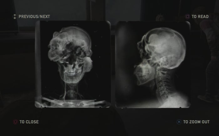 Found in the University, this X-Ray shows the idea of what the fungus actually does to the human brain to create "clickers".