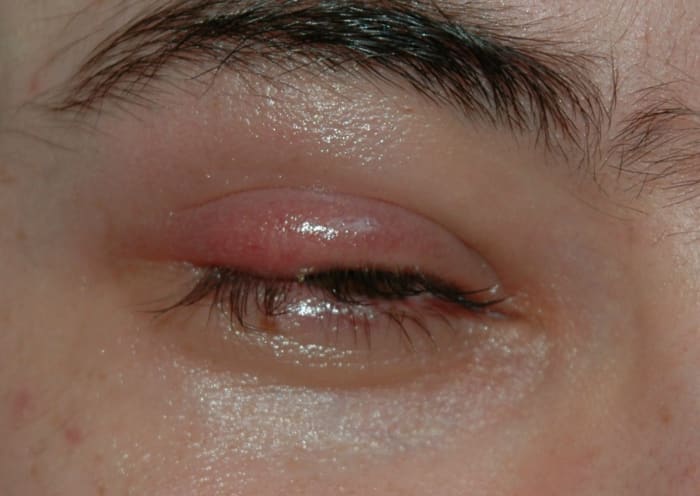 22 Home Remedies To Get Rid Of Styes With Photos RemedyGrove 