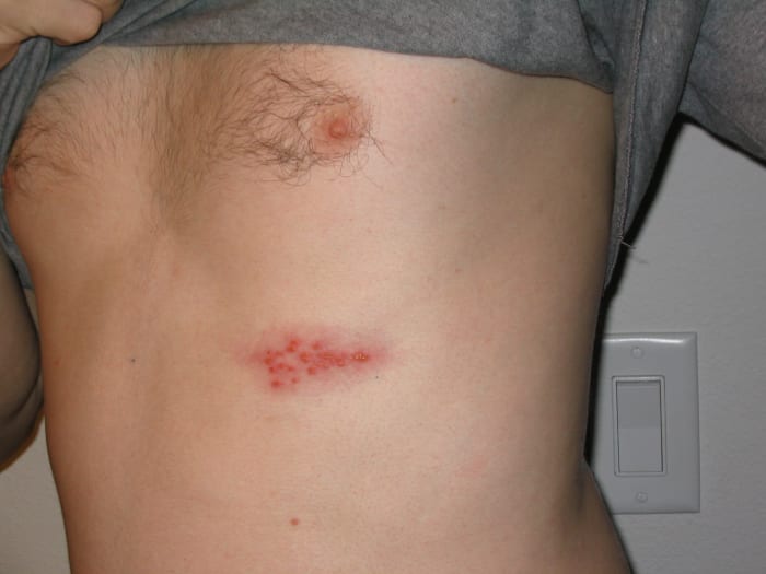 Shingles on chest